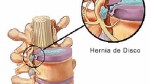 hernia_discal_140